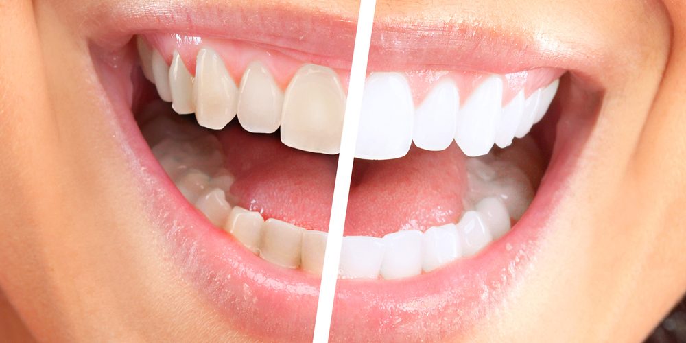 Happy,Smiling,Woman.,Dental,Health,Background. teeth whitening near me