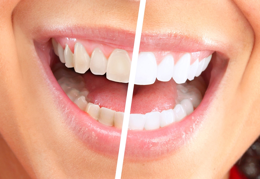 teeth whitening near me