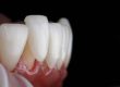 dental crowns auburn