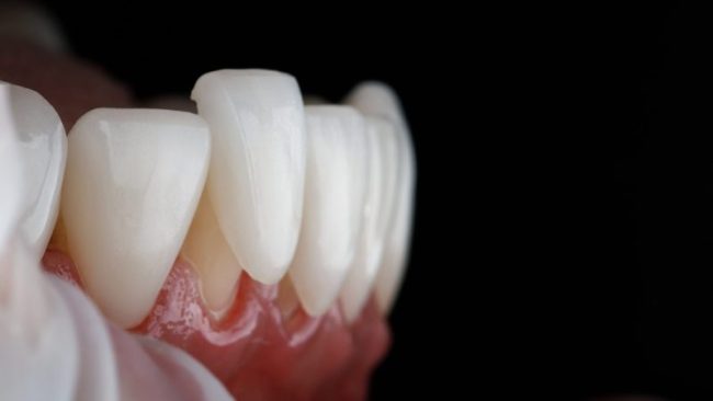 Macro,Dental,Photo,Of,A,Veneer,With,Fitting,On,The dental crowns auburn