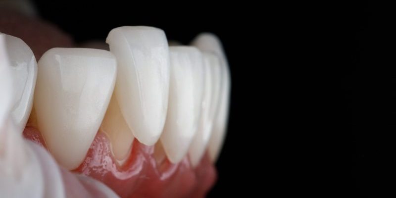Macro,Dental,Photo,Of,A,Veneer,With,Fitting,On,The dental crowns auburn