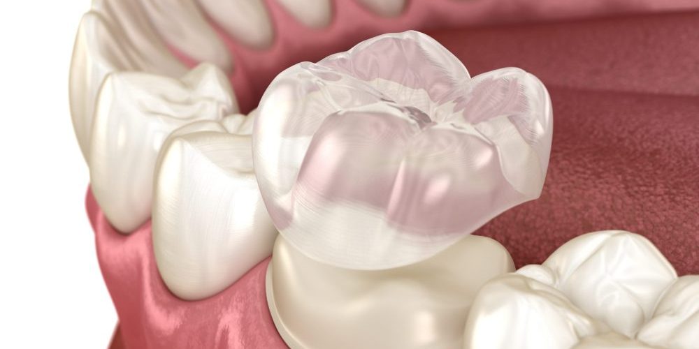 Preparated,Molar,Tooth,For,Dental,Crown,Placement.,Medically,Accurate,3d types of crowns auburn