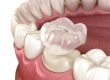 types of crowns auburn