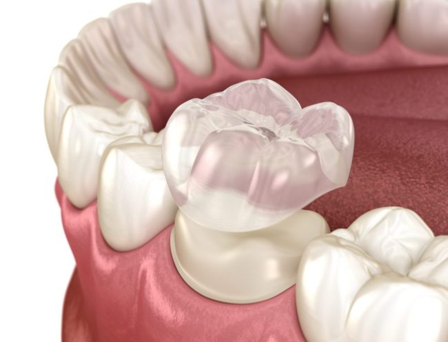 Preparated,Molar,Tooth,For,Dental,Crown,Placement.,Medically,Accurate,3d types of crowns auburn