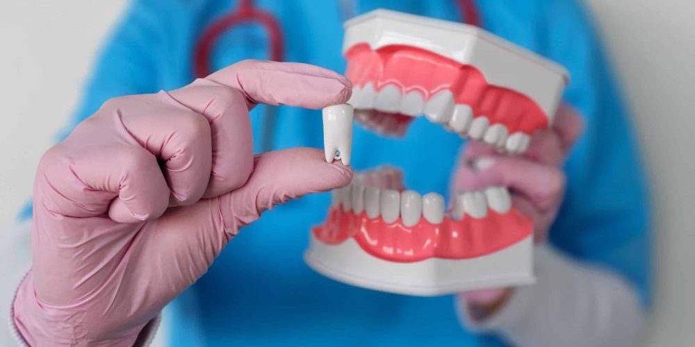 Dentist,Demonstrating,Dental,Implant,Using,Model,Teeth,In,Clinical,Environment what can you eat after removal of wisdom teeth